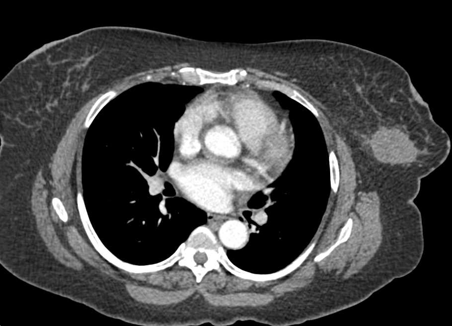 Hematoma Left Breast - CTisus CT Scan
