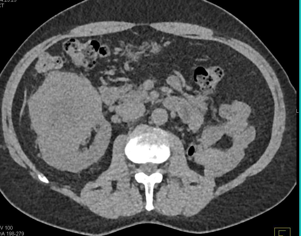 Clear Cell Renal Cell Carcinoma (RCC) - CTisus CT Scan