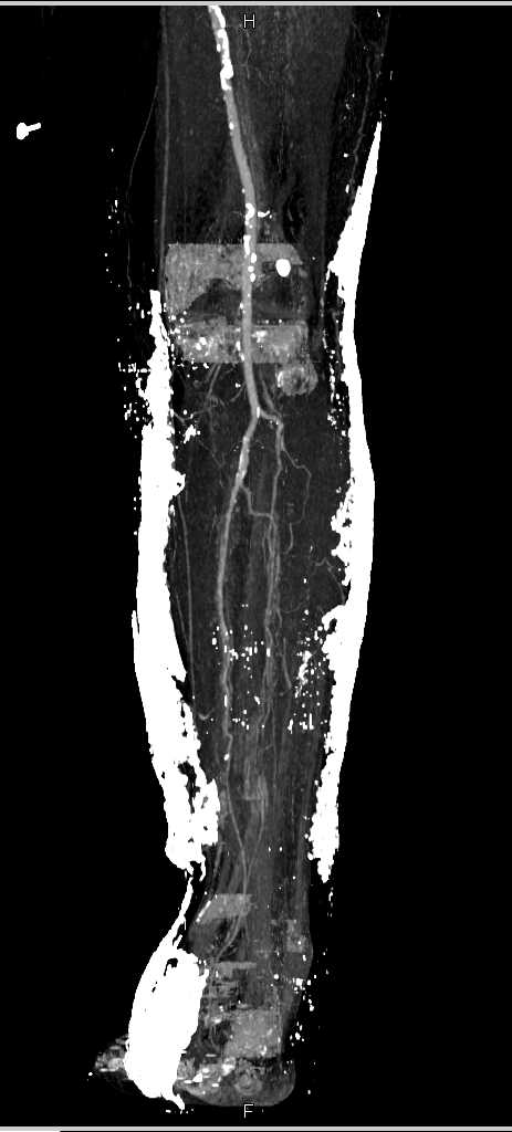 Open Fracture Tibia - CTisus CT Scan