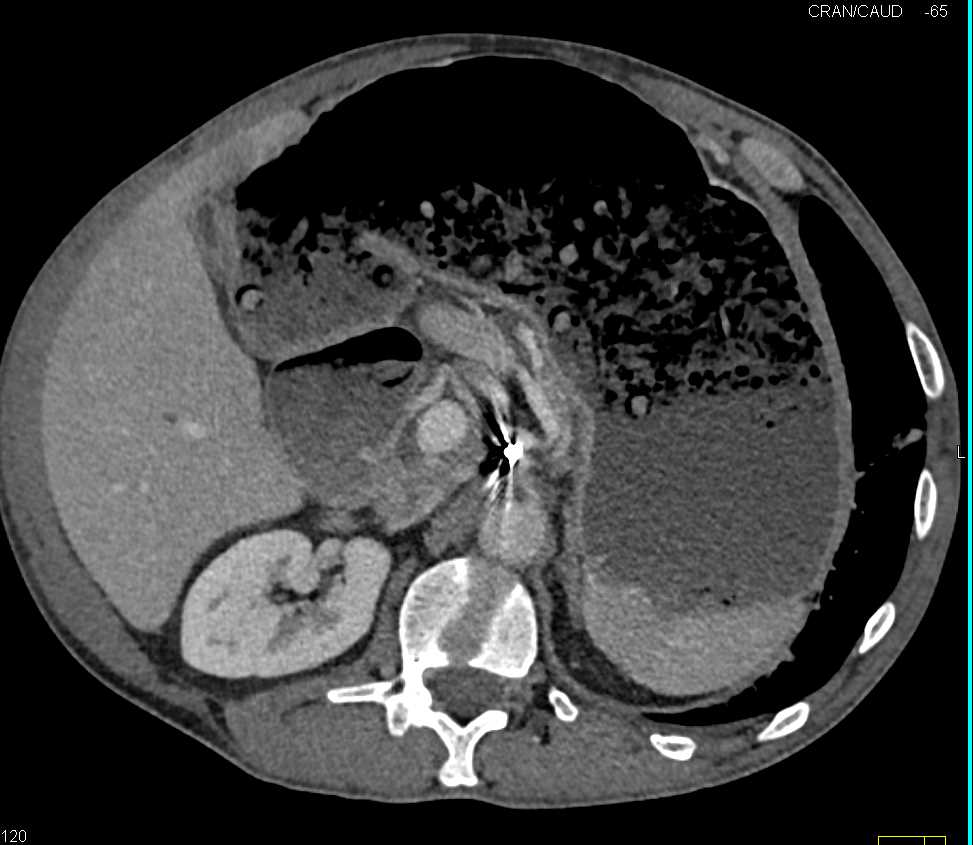 Delayed Gastric Emptying - CTisus CT Scan
