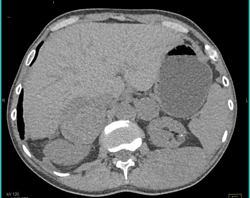 Metastatic Melanoma to Chest , Adrenals and Muscle - CTisus CT Scan
