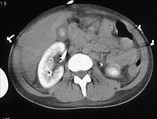 ct urography with iv contrast