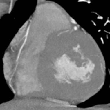 Concentric left ventricular hypertrophy which can be seen with aortic stenosis 