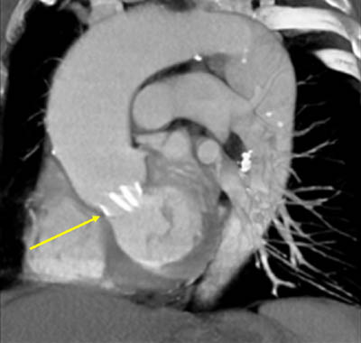 Mechanical aortic valve, bileaflet type 