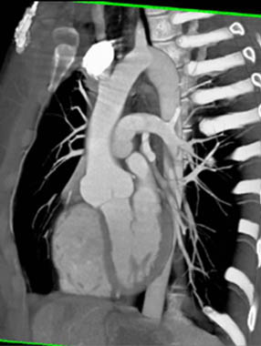 Normal aortic valve - diastole