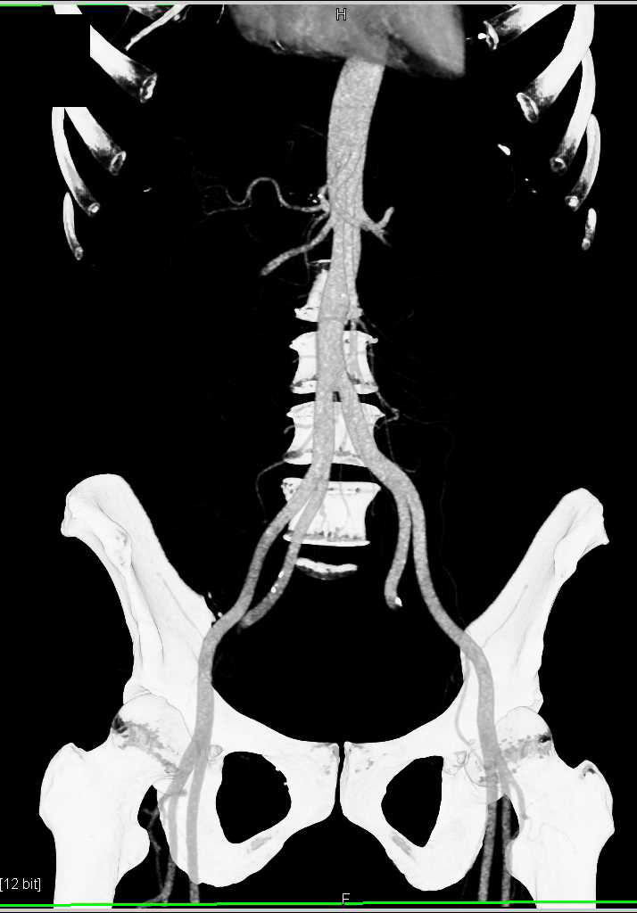 2cm Pheochromocytoma at Aortic Bifurcation (organ of Zuckerkandl) - CTisus CT Scan