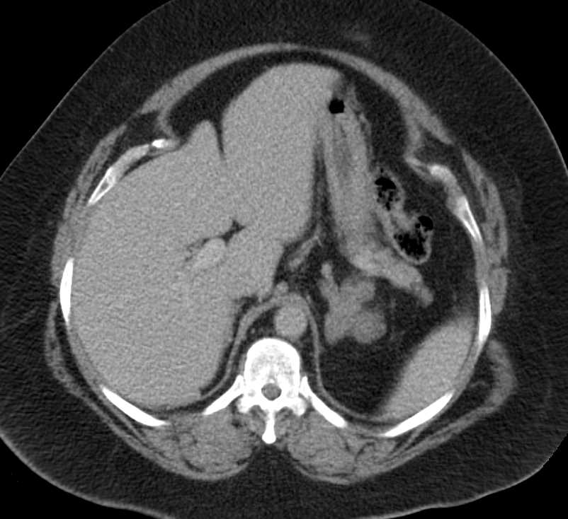 Adenomatous Hyperplasia of the Adrenal Gland - CTisus CT Scan