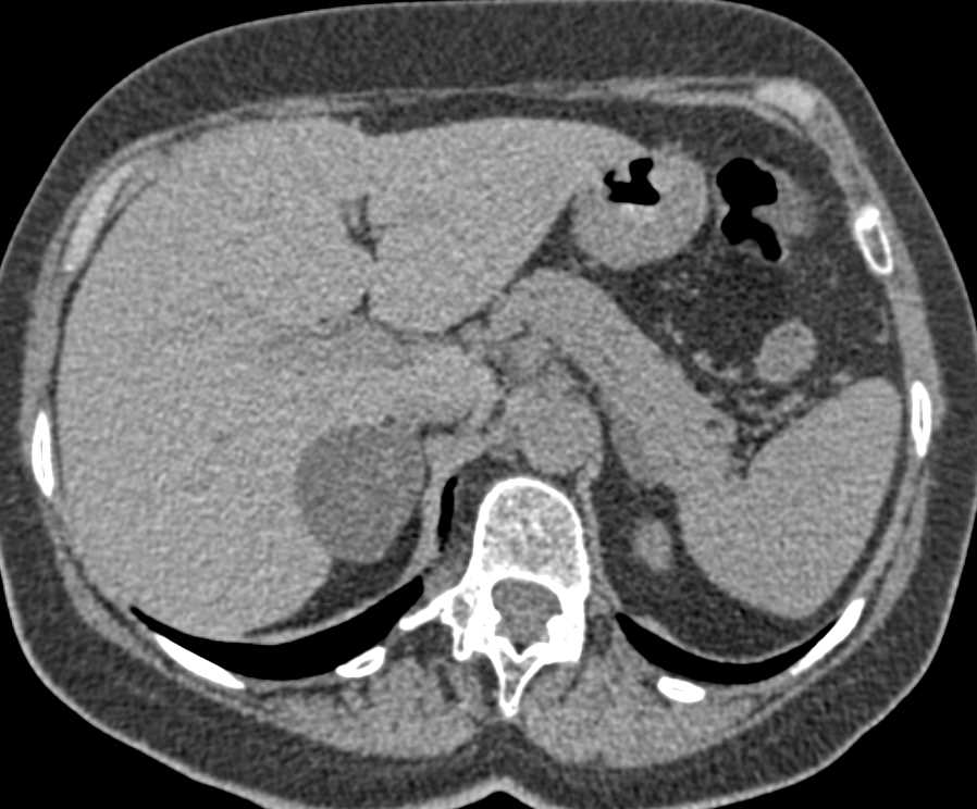 Right Adrenal Adenoma - CTisus CT Scan