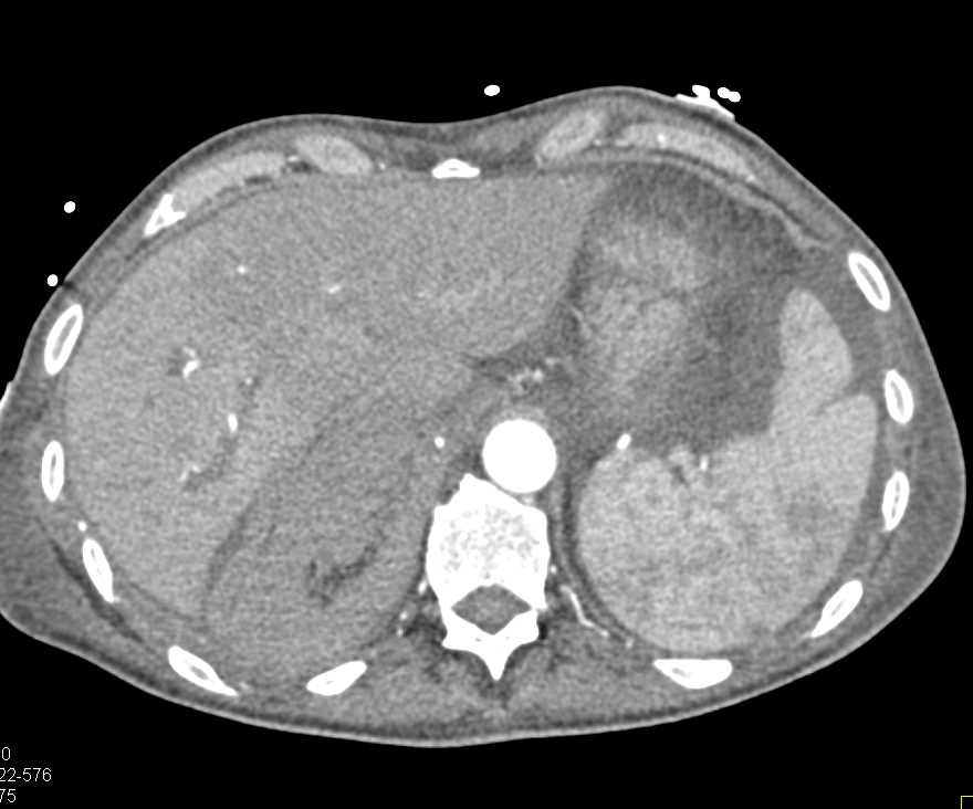 Large Right Adrenal Bleed - CTisus CT Scan