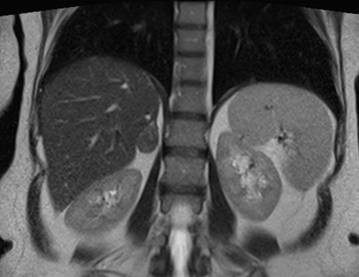 Adrenal Adenoma - CTisus CT Scan