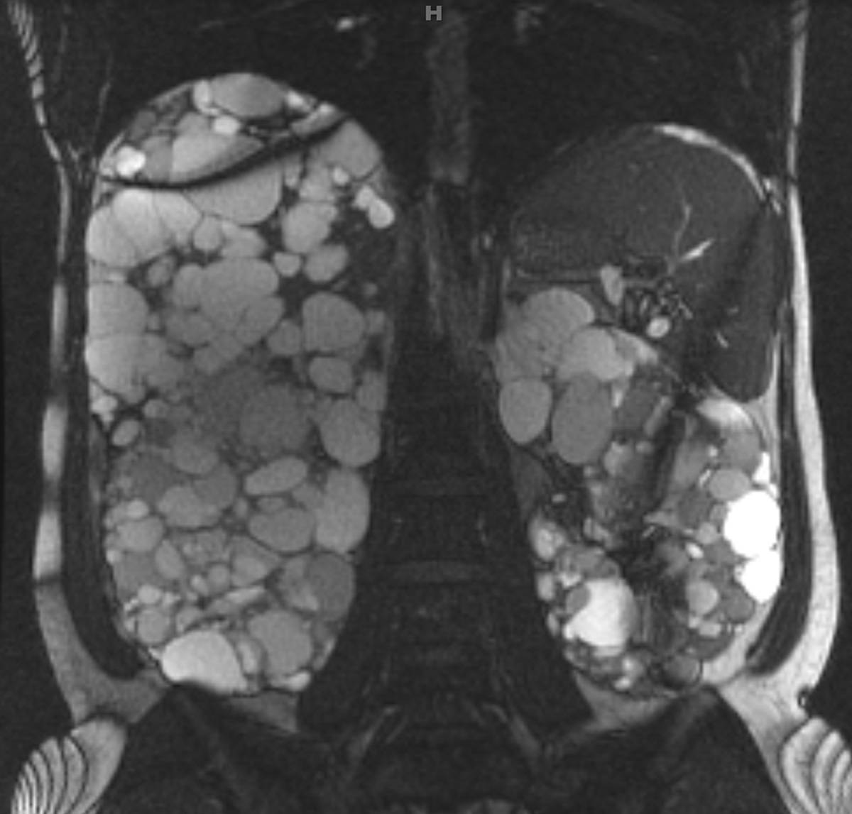 Autosomal Dominant Polycystic Hepatorenal Syndrome. - CTisus CT Scan
