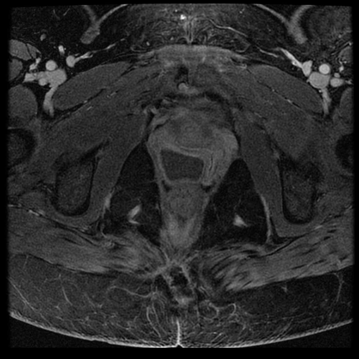 Gartner duct cyst - CTisus CT Scan