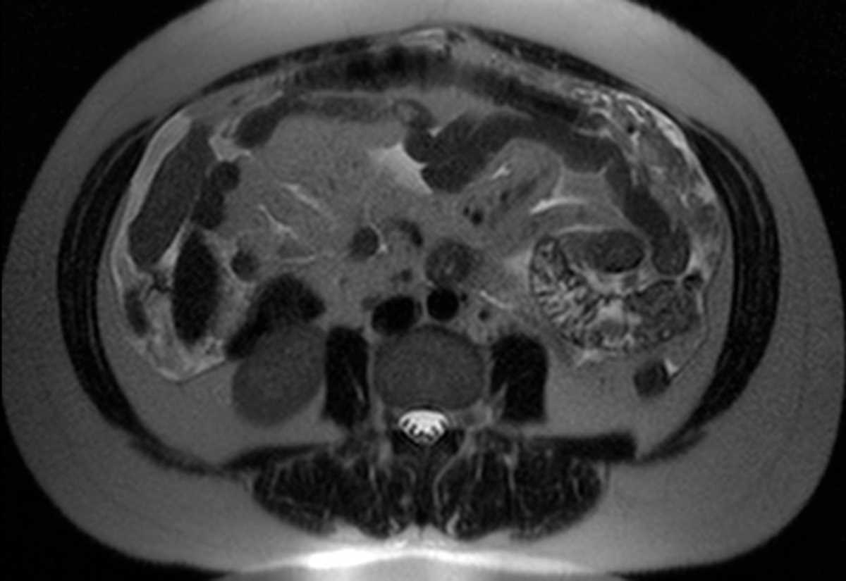 Primary peritoneal carcinomatosis - CTisus CT Scan