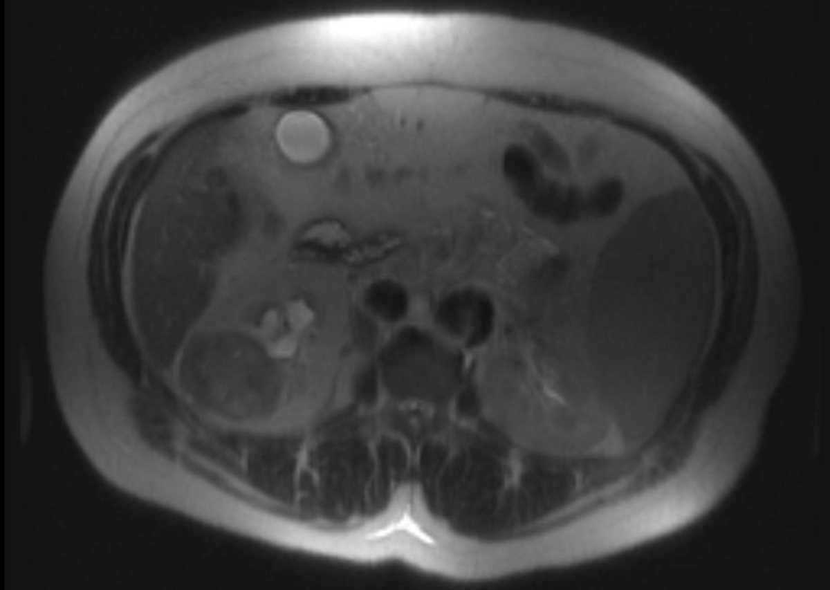 Renal medullary carcinoma - CTisus CT Scan