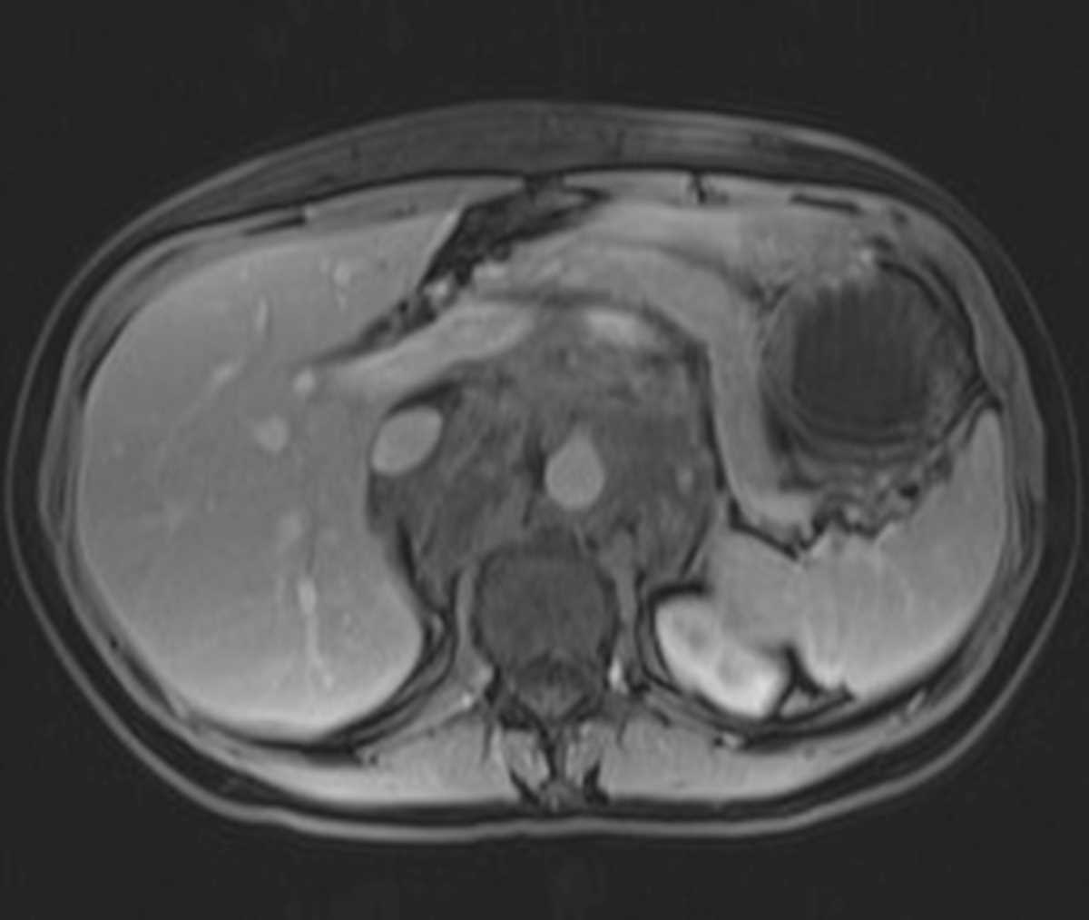 Retroperitoneal Ganglioneuroma - CTisus CT Scan