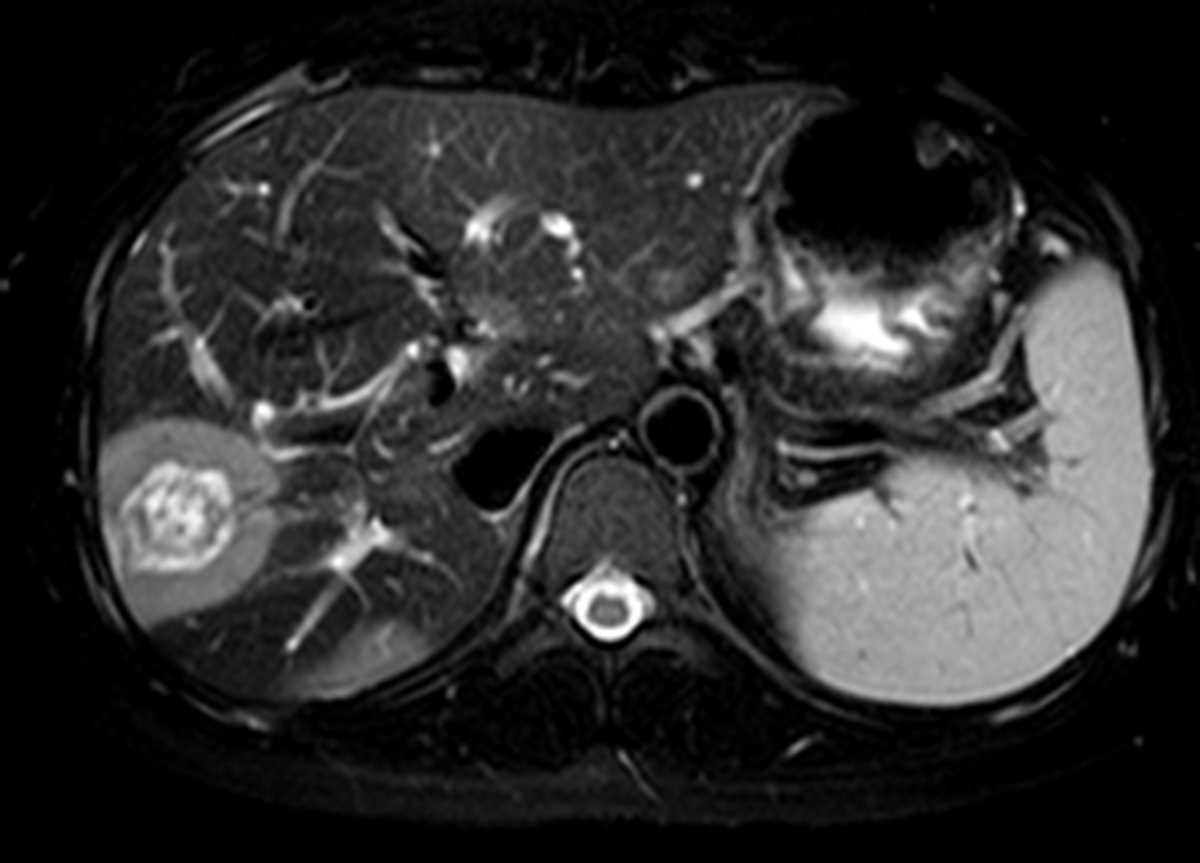 Hepatic Epithelioid Hemangioendothelioma - CTisus CT Scan