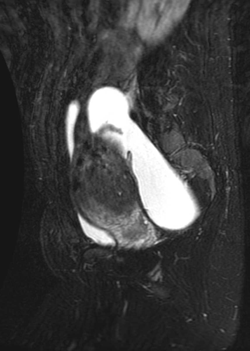 Hematosalpinx from endometriosis - CTisus CT Scan