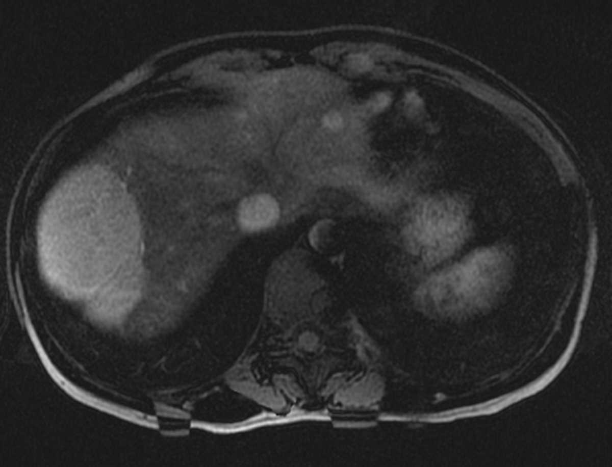 Multiple Focal Nodular Hyperplasia (FNH) with Eovist - CTisus CT Scan