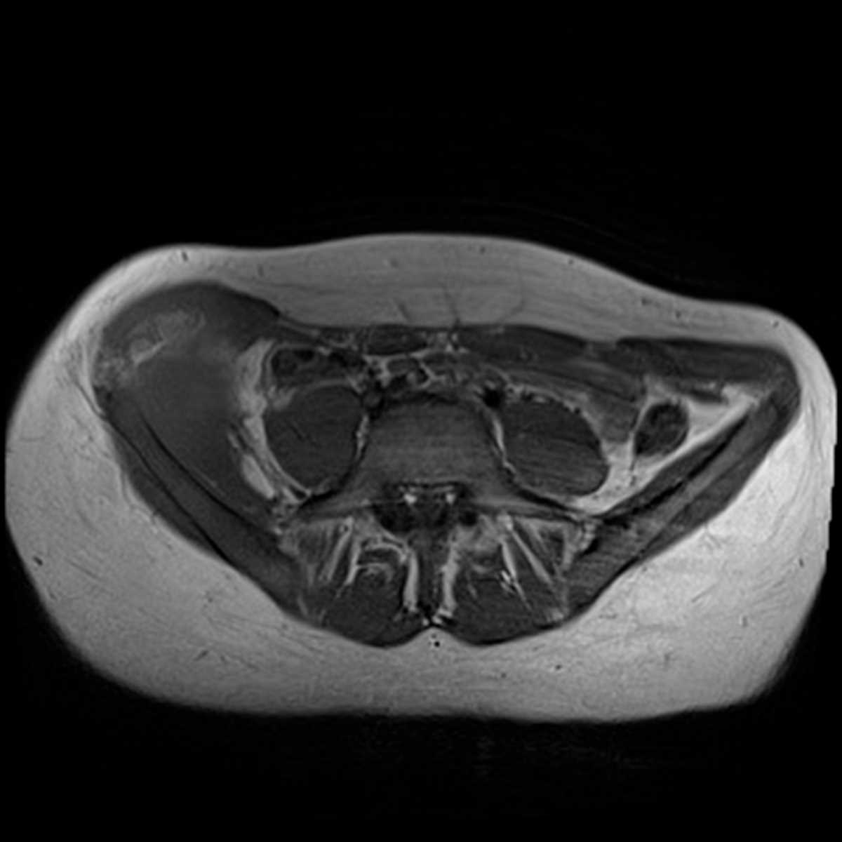 Osteosarcoma of the iliac crest - CTisus CT Scan