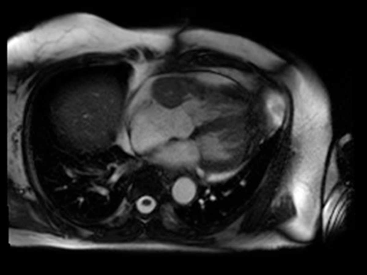 Primary cardiac lymphoma - CTisus CT Scan