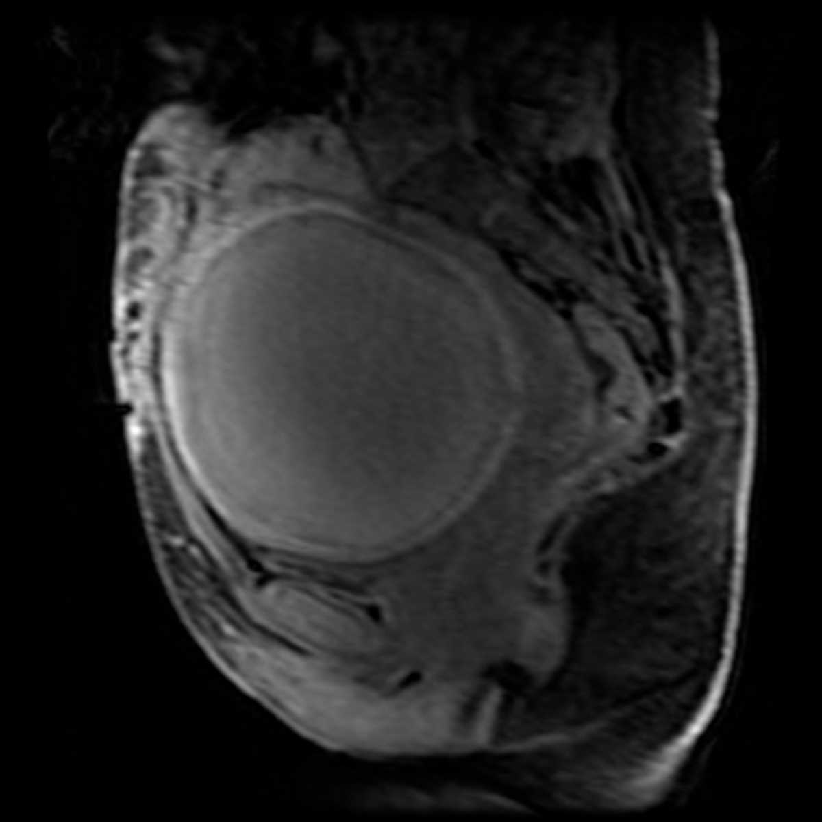 Red degeneration of uterine fibroid - CTisus CT Scan