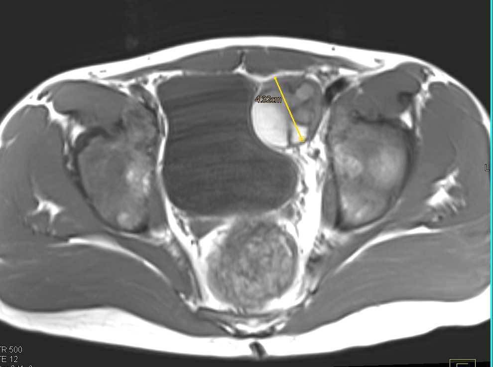 Ewing Sarcoma in the Pelvis - CTisus CT Scan