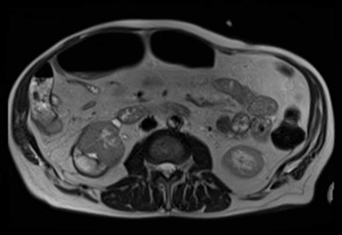 Renal Subcapsular Hematoma - CTisus CT Scan