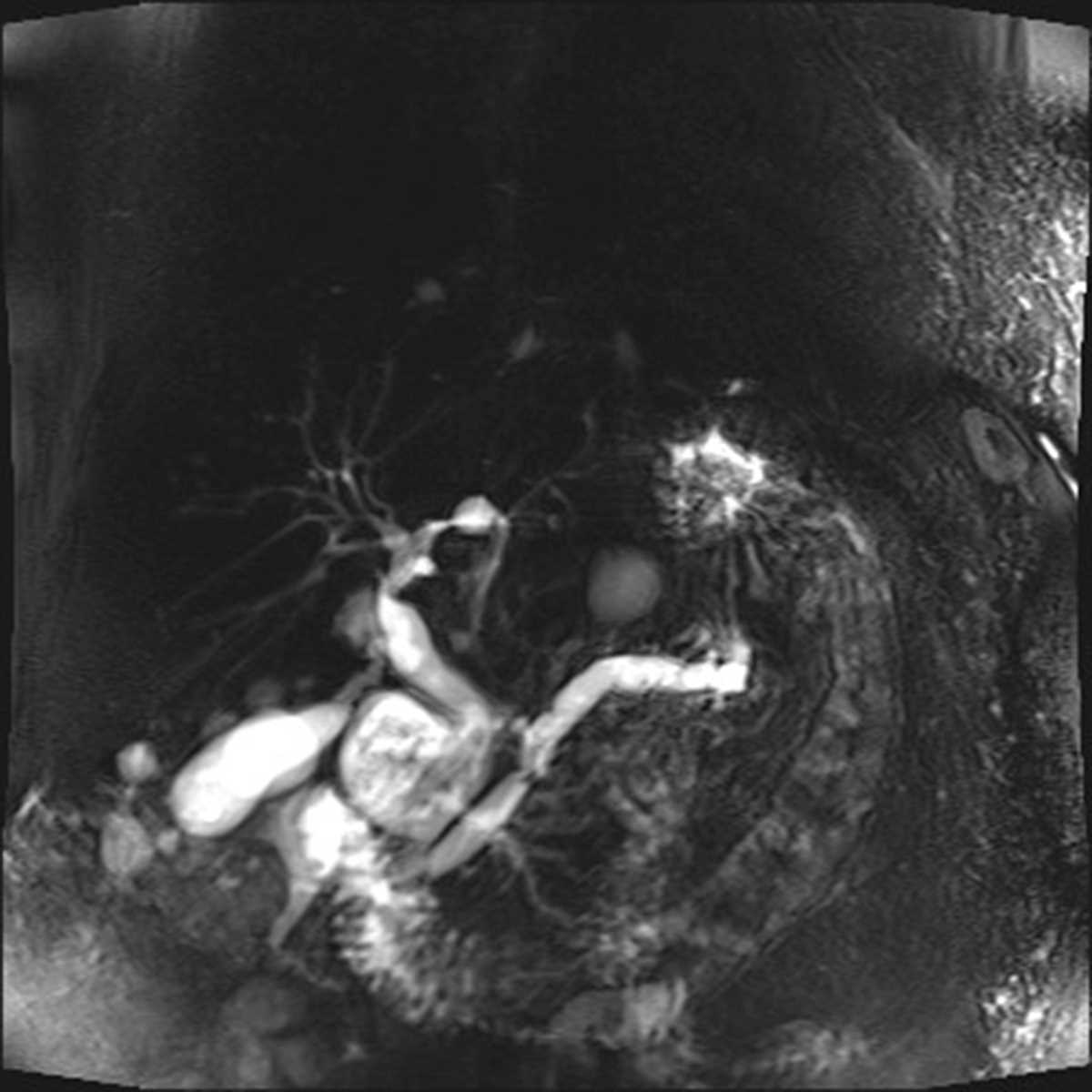 Main-duct Intraductal Papillary Mucinous Neoplasm (IPMN) - CTisus CT Scan