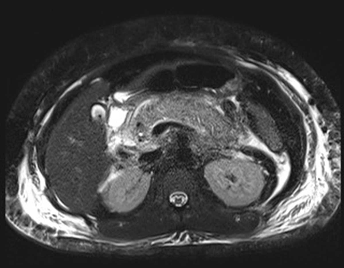 Acute Pancreatitis - CTisus CT Scan