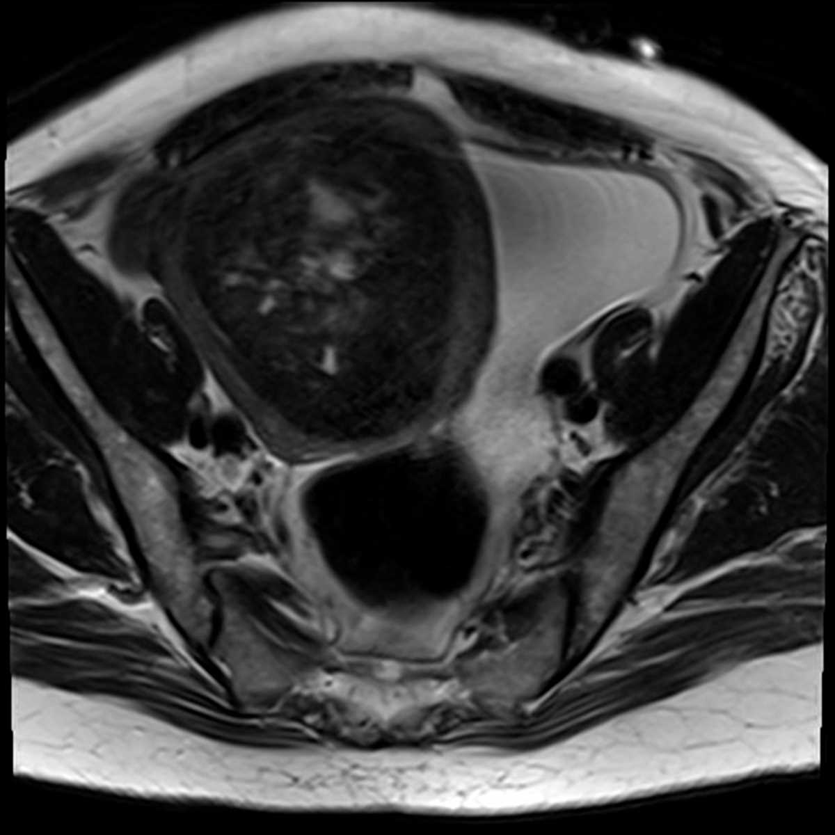 Uterine Fibroid - CTisus CT Scan