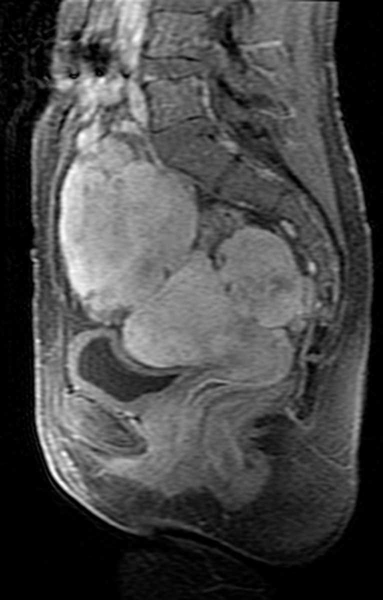 Krukenberg Tumors - CTisus CT Scan