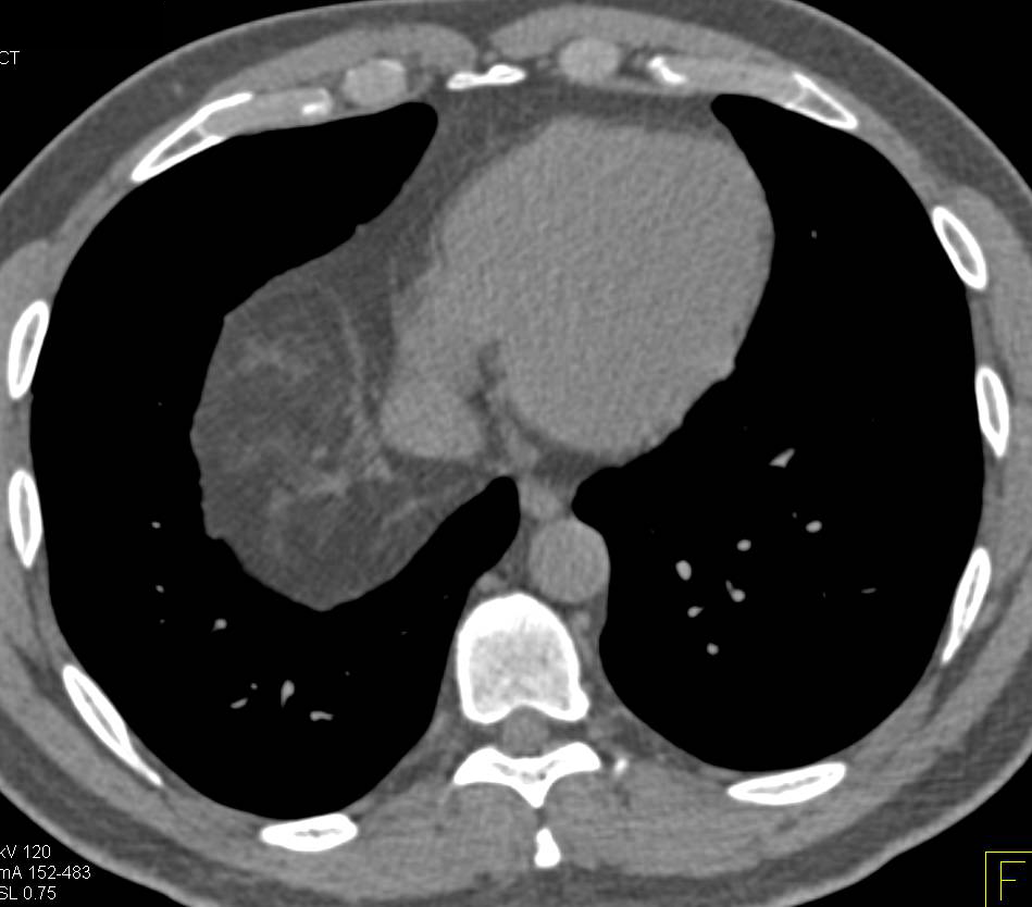 Lipoma of Pericardial fat Pad (Benign) - CTisus CT Scan