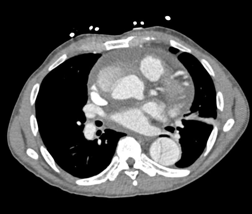 Type A Dissection with Hemopericardium - CTisus CT Scan