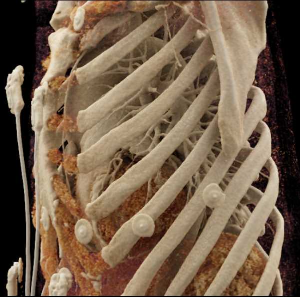 Bicuspid Aortic Valve wth Calcification - CTisus CT Scan