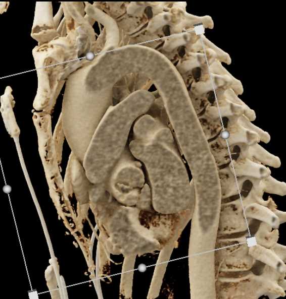 Good Visualization of the Left Atrial Appendage - CTisus CT Scan