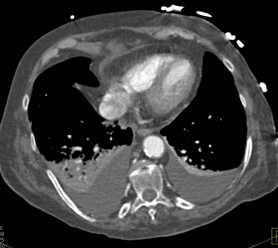 Pulmonary Embolism Pulmonary Artery to the Right Pulmonary Artery (Right Lower Lobe) with Cutoff - CTisus CT Scan