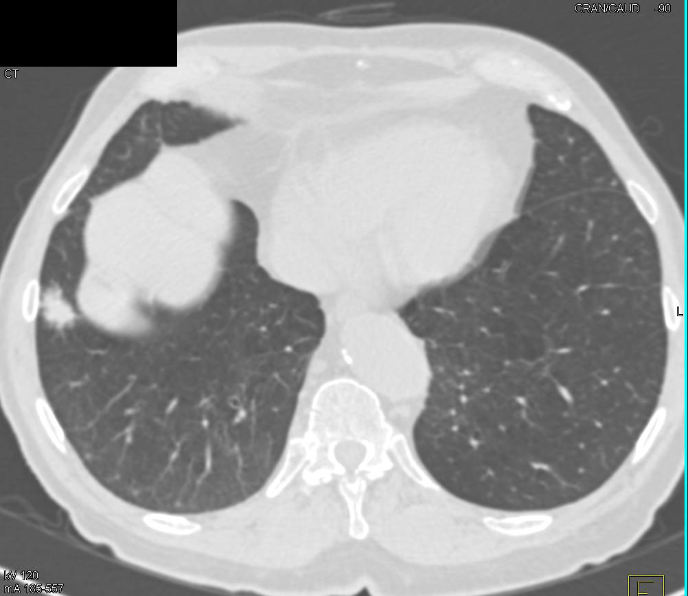 Scar Carcinoma in Right Lower Lung - CTisus CT Scan