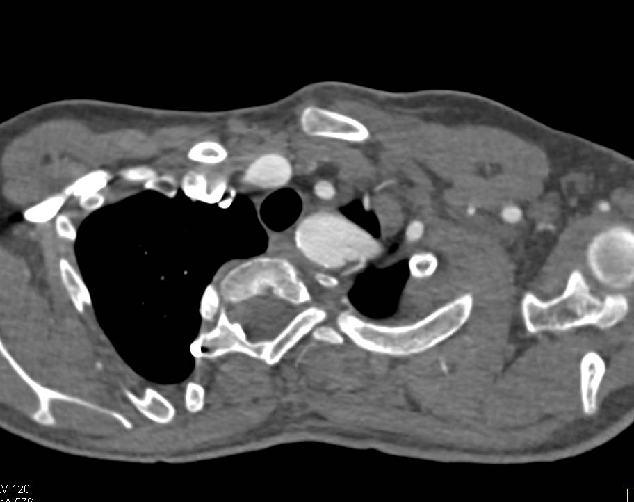Dillated Aortic Root and Left Subclavian Artery - CTisus CT Scan