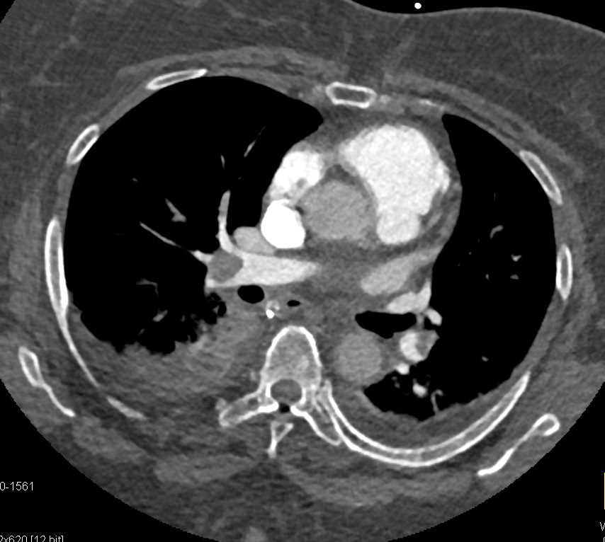 Multiple Bilateral Pulmonary Embolism and Clots in Mesenteric Vessels - CTisus CT Scan