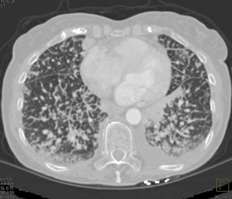 Lymphangitic Spread due to Lung Cancer - CTisus CT Scan