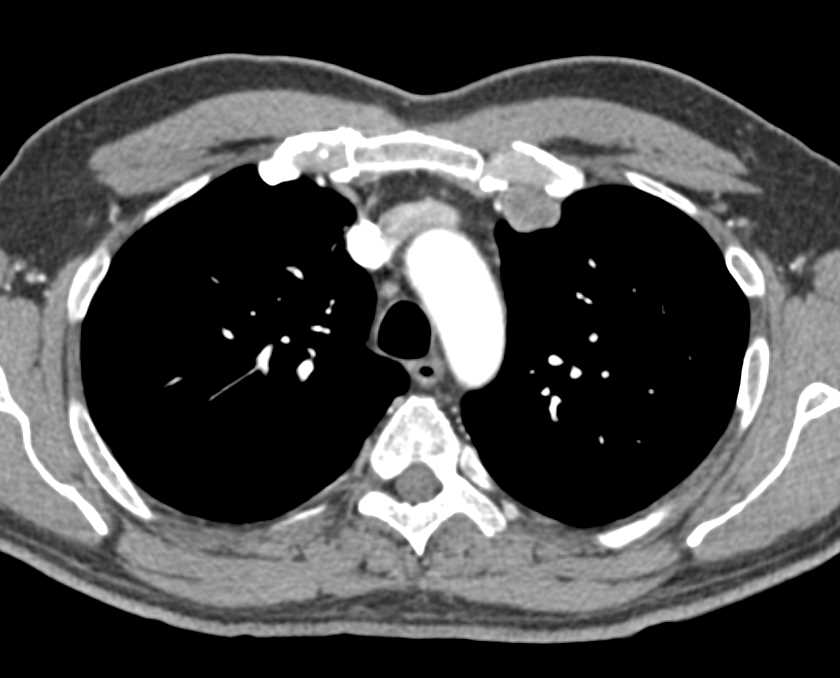 Metastatic Melanoma to the Internal Mammary and Pericardiac Nodal Chain and More - CTisus CT Scan