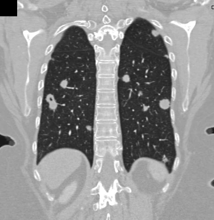 Metastatic Renal Cell Carcinoma to the Lungs - CTisus CT Scan