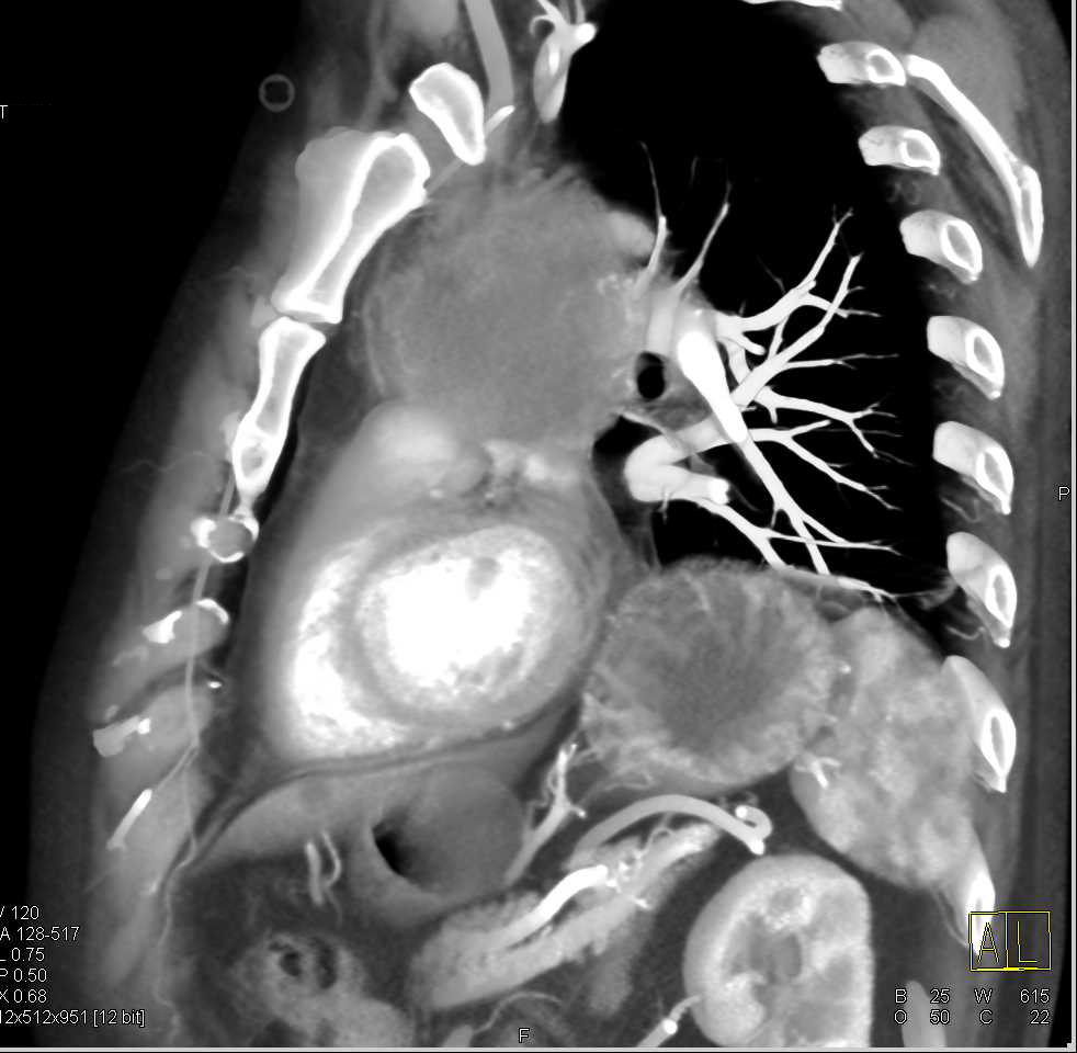 Invasive Thymoma - CTisus CT Scan