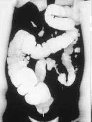 Apple Core Sigmoid Cancer - CTisus CT Scan