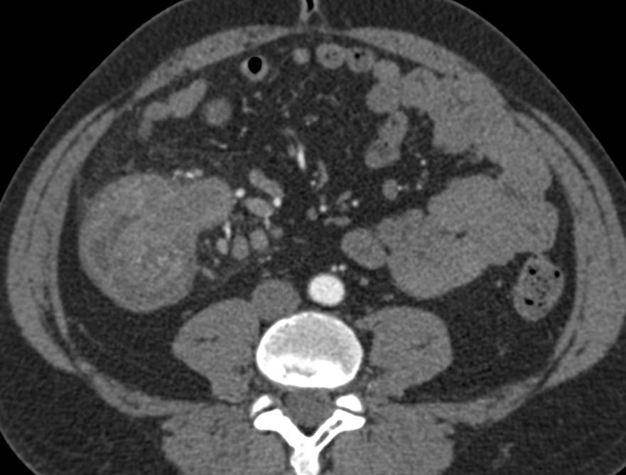 Carcinoma of the Cecum with Local Adenopathy in 2D and 3D Display - CTisus CT Scan