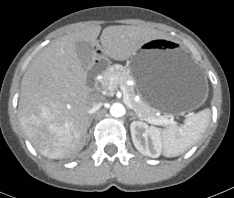 Cecal Carcinoid Tumor with Mesenteric Mass and Liver Metastases - CTisus CT Scan