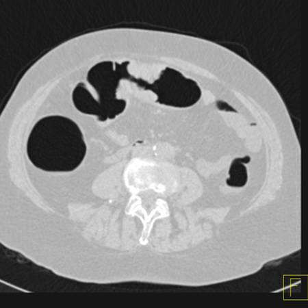 virtual colon: Cancer (apple core lesion) transverse colon - CTisus CT Scan