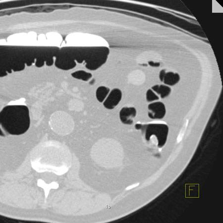 virtual colon: Large, 1.5 cm polyp descending colon - CTisus CT Scan