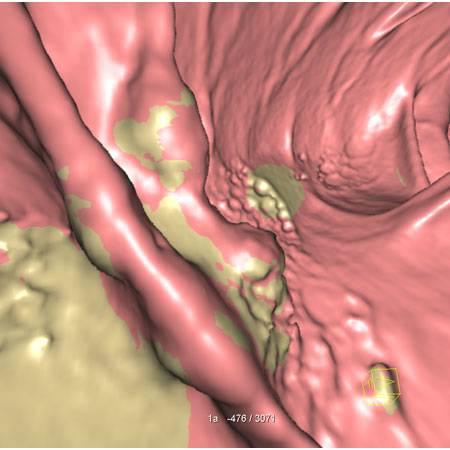 virtual colon: 4 cm mass ascending colon. - CTisus CT Scan