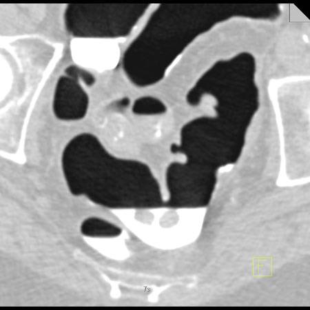 virtual colon: Mobile pills. Patient has Scleroderma. Notice the contour of the colon on the global images - CTisus CT Scan